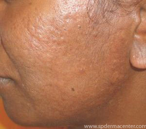 Acne-Scar-After